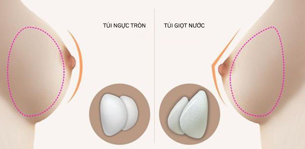 Nâng ngực túi mentor giọt nước