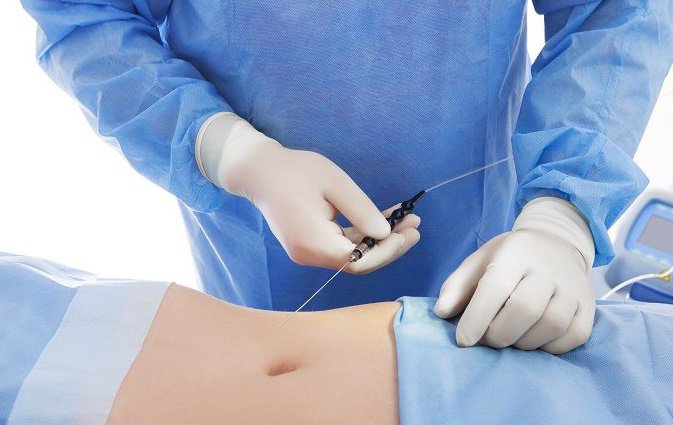 Phẫu thuật căng da bụng sau sinh