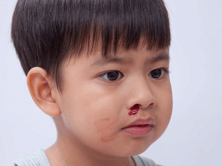 Trẻ thỉnh thoảng bị chảy máu cam có nguy hiểm không?