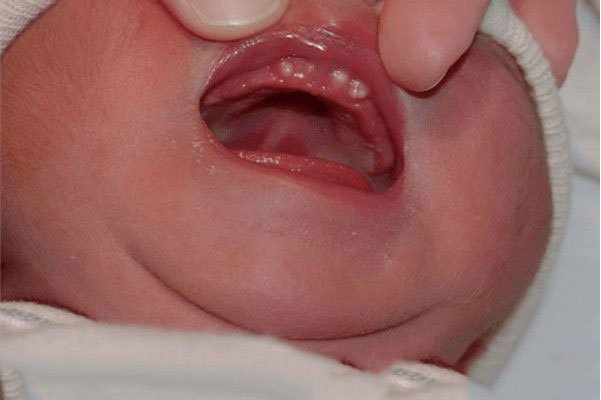 Bé 1 tháng tuổi mọc răng nanh có nguy hiểm không?