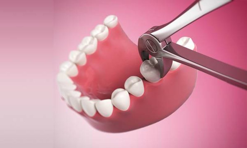 Nguyên nhân và cách điều trị đau đầu sau nhổ răng số 7 hàm dưới là gì?