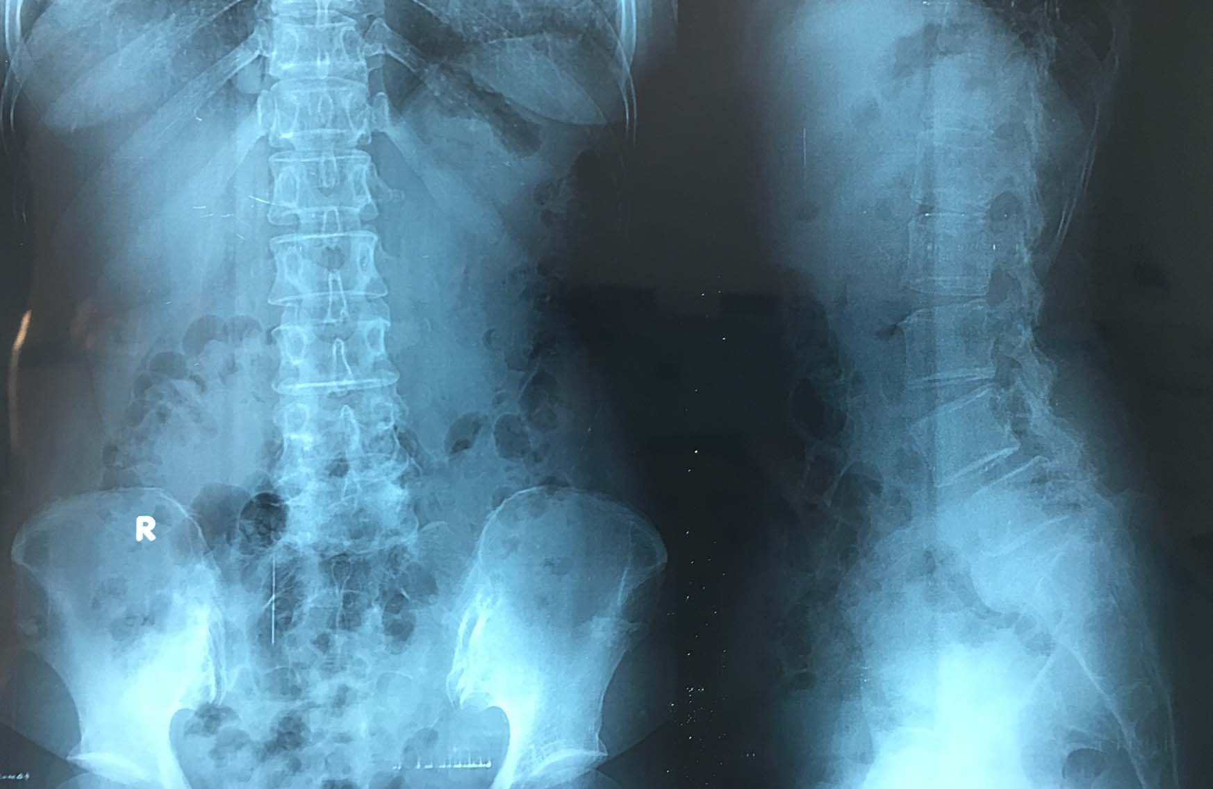Surgery to decompress spinal cord in tuberculosis of the spine