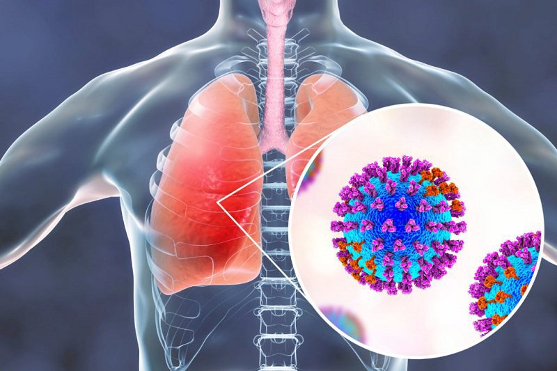 bệnh viêm phổi nặng do COVID-19