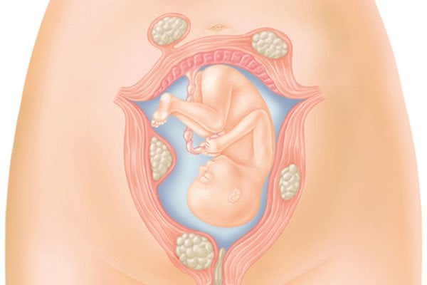 Người bệnh u xơ tử cung khi mang thai có nguy hiểm không?
