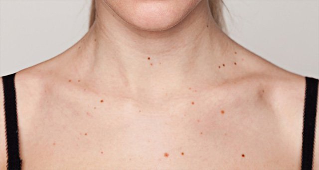 Xuất hiện các nốt sắc tố màu nâu đen ở lưng và ngực là bị bệnh gì?
