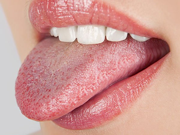 Tê đầu lưỡi, nóng rát miệng là dấu hiệu của bệnh gì?