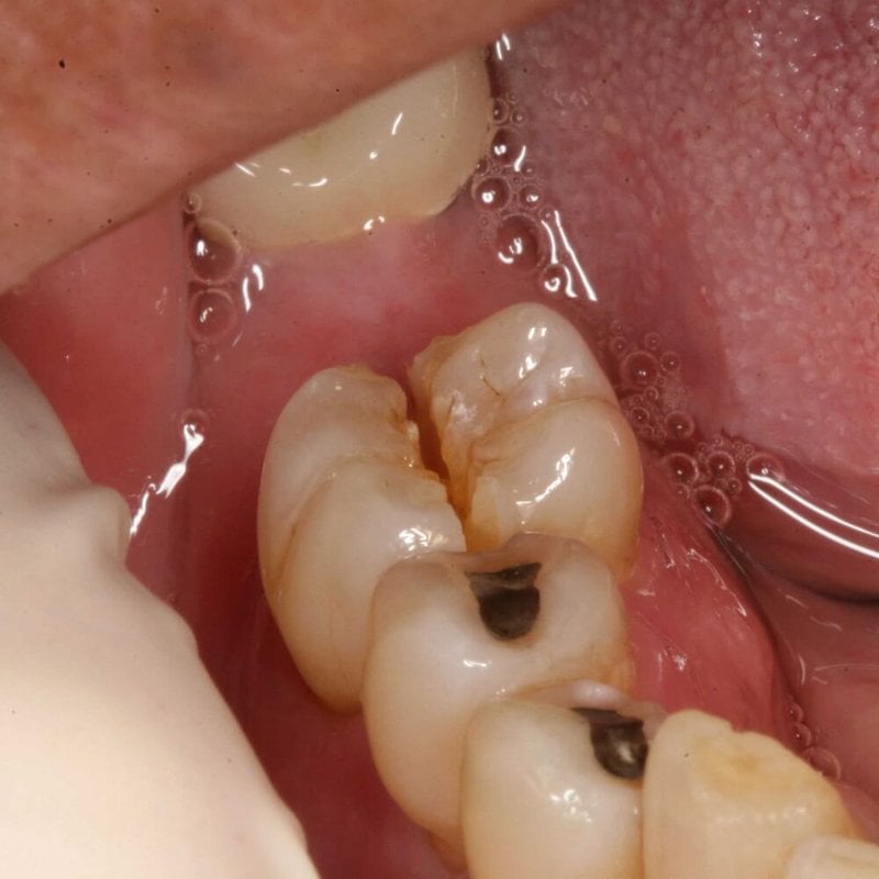 Răng hàm bị sâu và nứt có hàn được không?