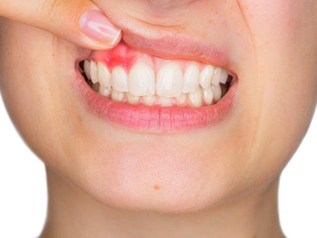 Cách vệ sinh răng miệng tránh tình trạng viêm lợi?