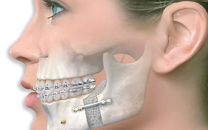 Nẹp vít xương hàm dưới có cần cố định hai hàm răng bằng chun không?