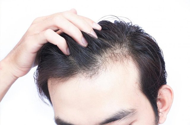Nguyên nhân rụng tóc ở đỉnh đầu là gì?