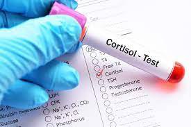 Xét nghiệm nồng độ corticoid cho biết điều gì?