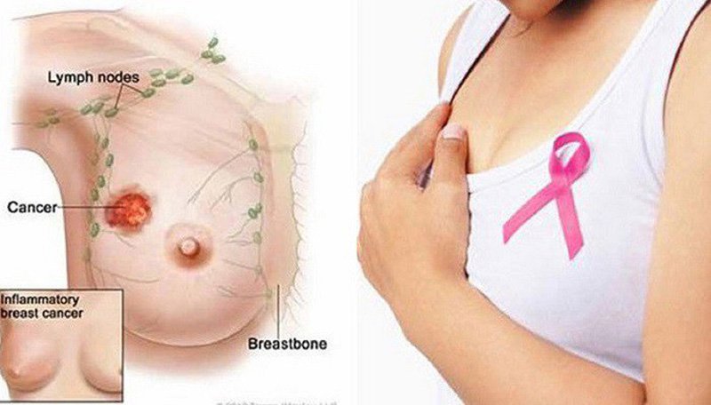 Nổi cục u nhỏ ở vú có phải bị ung thư vú không?