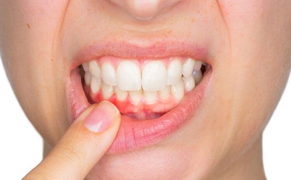 Bị viêm nướu răng hàm dưới thì phải làm sao?