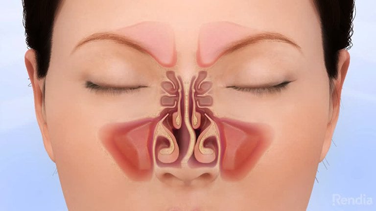 Phẫu thuật vách ngăn mũi có hiệu quả không?