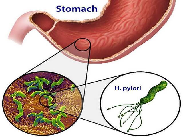 Điều trị viêm loét dạ dày H.Pylori dương tính như thế nào?