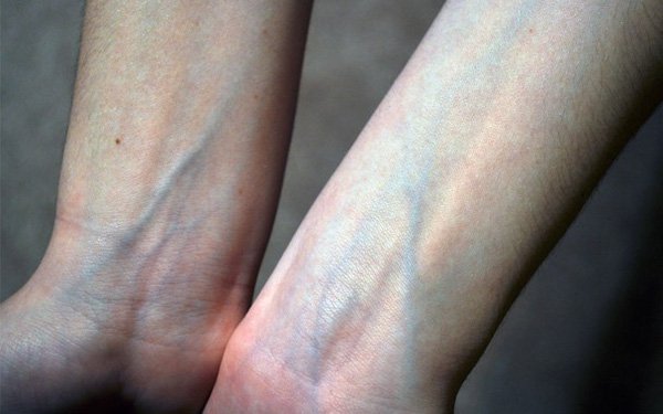 Nổi đường màu xanh ở tay, ngực, chân là bệnh gì?