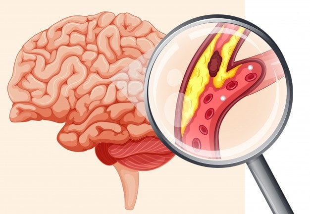 Tắc nghẽn mạch máu não có gây đau đầu không?