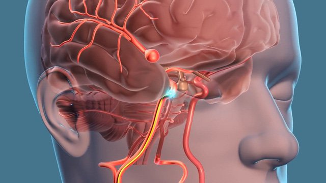 Làm thế nào để phát hiện tình trạng phình mạch máu não?