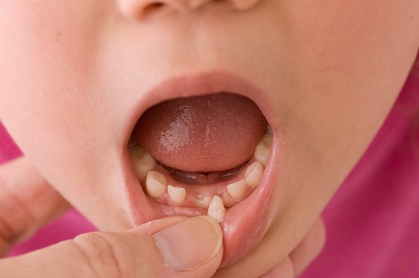 Có nên nhổ răng sữa khi trẻ đang bị sốt không?