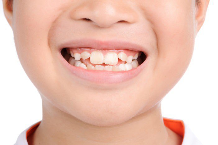 Răng mọc chậm nguyên nhân là gì?