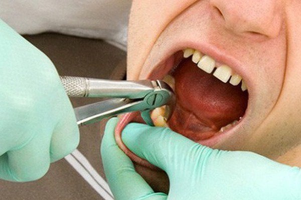 Có nên nhổ răng khi đang uống thuốc chống đông máu?