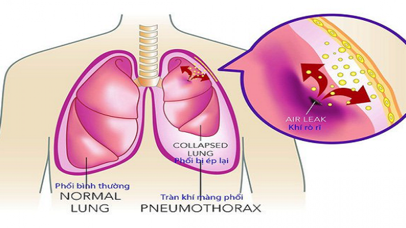Biện pháp giúp tránh tái phát tràn khí màng phổi?
