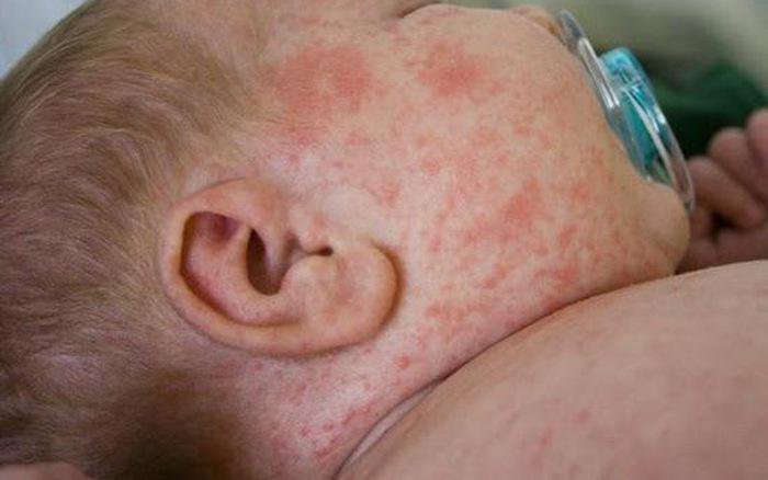 Trẻ bị sốt xuất huyết phát ban có nguy hiểm không?