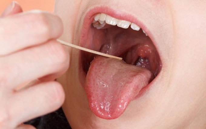 Điều trị thiếu lưỡi gà bẩm sinh như thế nào?