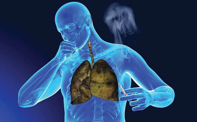 Ung thư phổi và các bệnh lý đường hô hấp