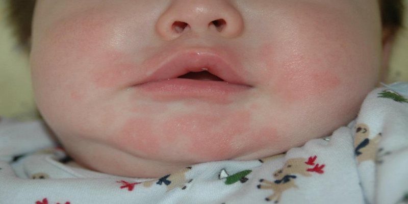 Trẻ nổi đỏ quanh miệng, cổ sau bú sữa công thức có sao không?