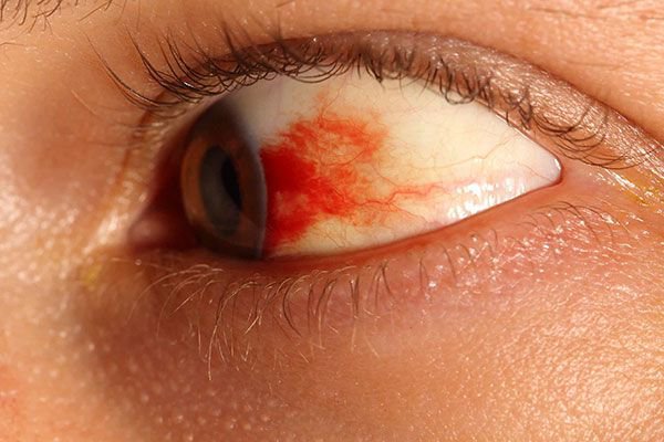 Nổi gân đỏ ở mắt là biểu hiện của bệnh gì?