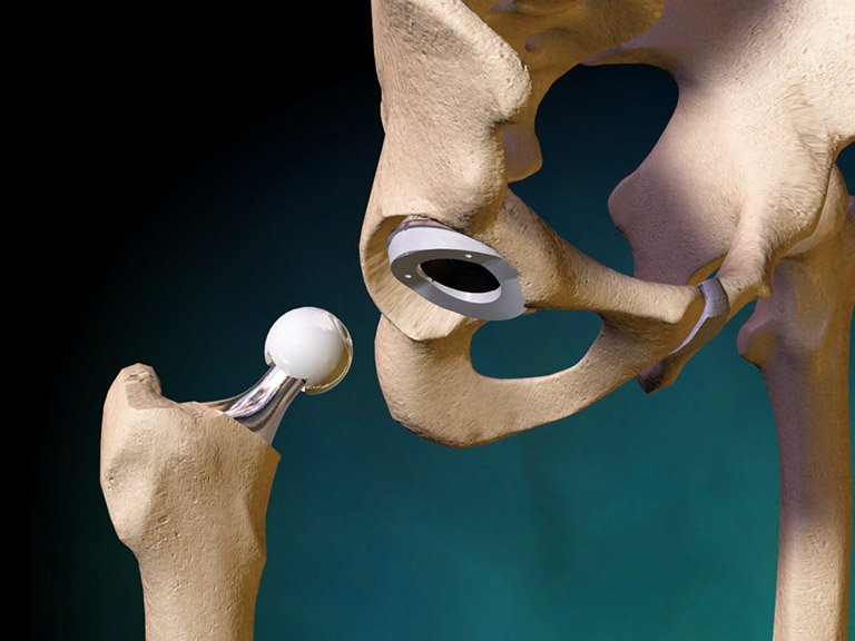 Hoại tử chỏm xương đùi có thể điều trị bằng cách thay khớp háng