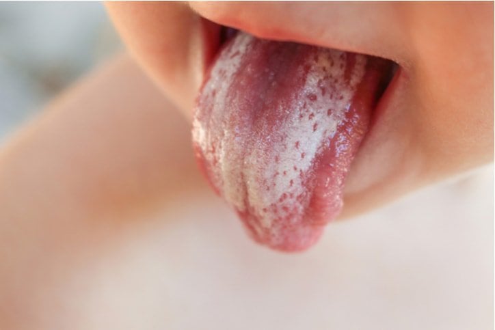 Trẻ viêm nướu, lưỡi trắng nguyên nhân là gì?
