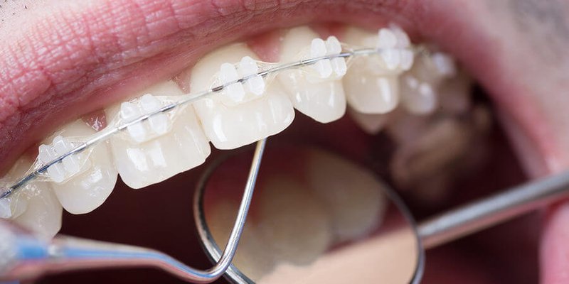 Có thể niềng răng kéo răng nanh ngầm khi mất một răng hàm dưới không?