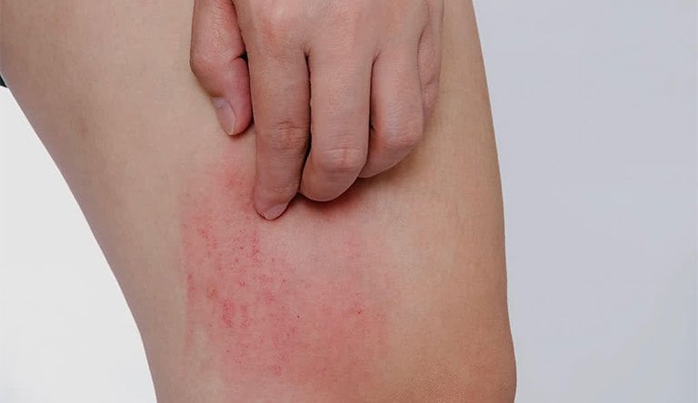 Xuất hiện các vết tím trên da sau gãi ngứa là bị làm sao?