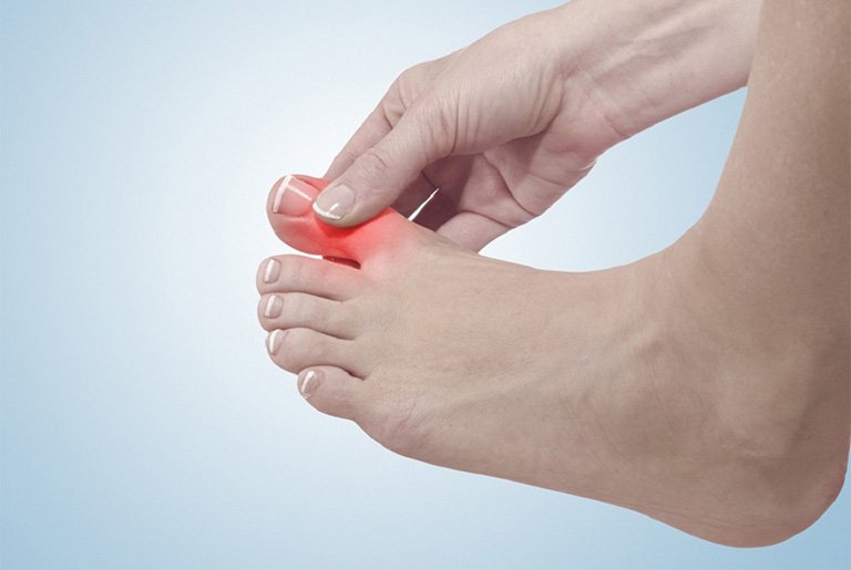 Nổi cục nhỏ ở ngón chân nứt xương, không đau là biểu hiện của bệnh gì?