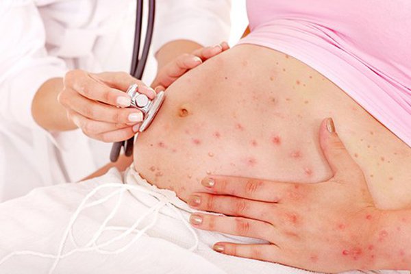 Nhiễm virus Rubella khi mang thai có nguy hiểm không?