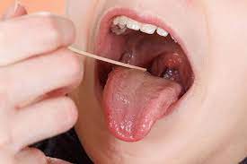 Họng và lưỡi nổi hạch, ngứa họng, ho là biểu hiện của bệnh gì?