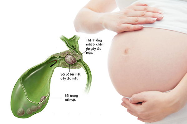 Phụ nữ mang thai 15 tuần có sỏi tắc ống mật chủ phải làm gì?