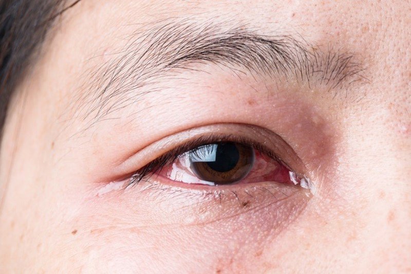 Đau mắt đỏ tái phát nhiều lần có nguy hiểm không?