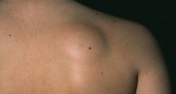 Khối u ở lưng là dấu hiệu của bệnh gì?