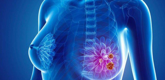 Bệnh nhân bị ung thư vú giai đoạn cuối di căn có điều trị được không?