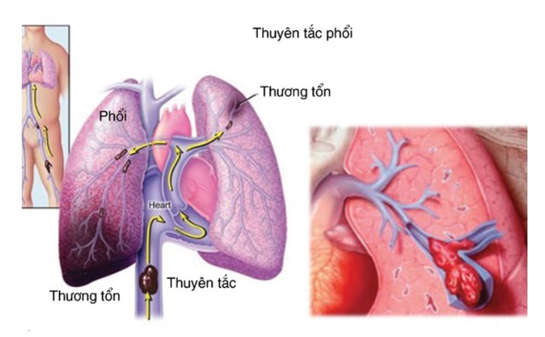 Huyết khối tĩnh mạch có thể gây tử vong do thuyên tắc phổi