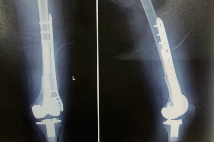 Hình ảnh chụp X-Quang của bệnh nhân sau mổ điều trị ung thư xương