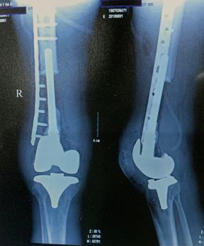 Hình ảnh chụp X-Quang của bệnh nhân sau mổ điều trị ung thư xương