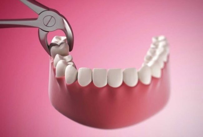 Nữ giới trồng răng giả sau khi nhổ răng khôn có ảnh hưởng gì không?