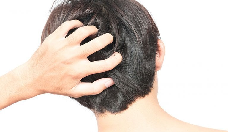 Da đầu nổi mụn kèm rụng tóc là dấu hiệu của bệnh gì?