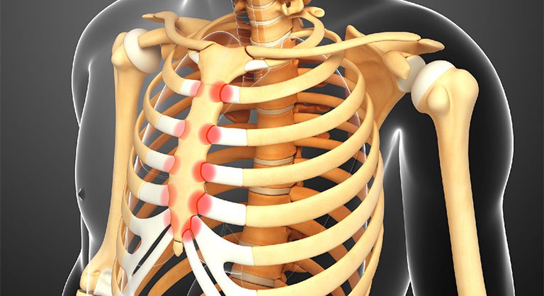Nguyên nhân đau phía trước ngực vùng xương sườn là do đâu?