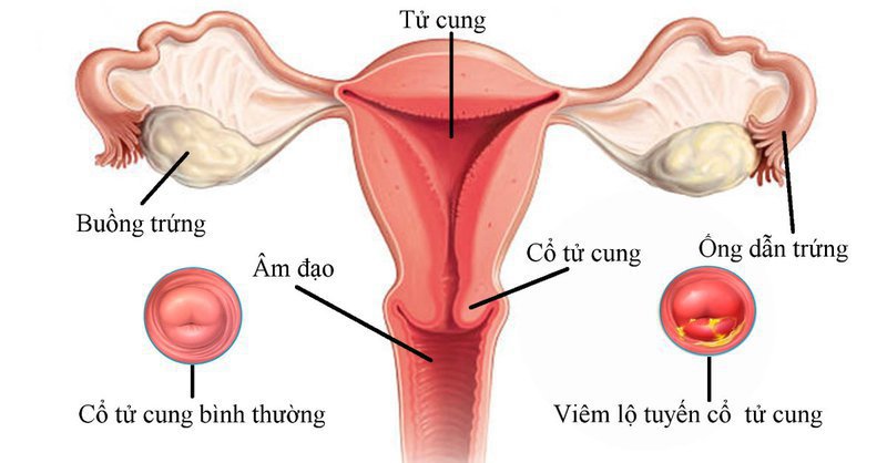 Nữ giới viêm nhiễm cổ tử cung giai đoạn 2 điều trị như thế nào?