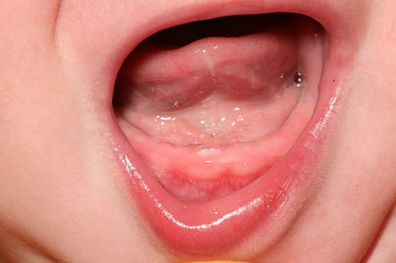 Trẻ 11 tháng nứt nướu, chưa mọc răng có ảnh hưởng gì?